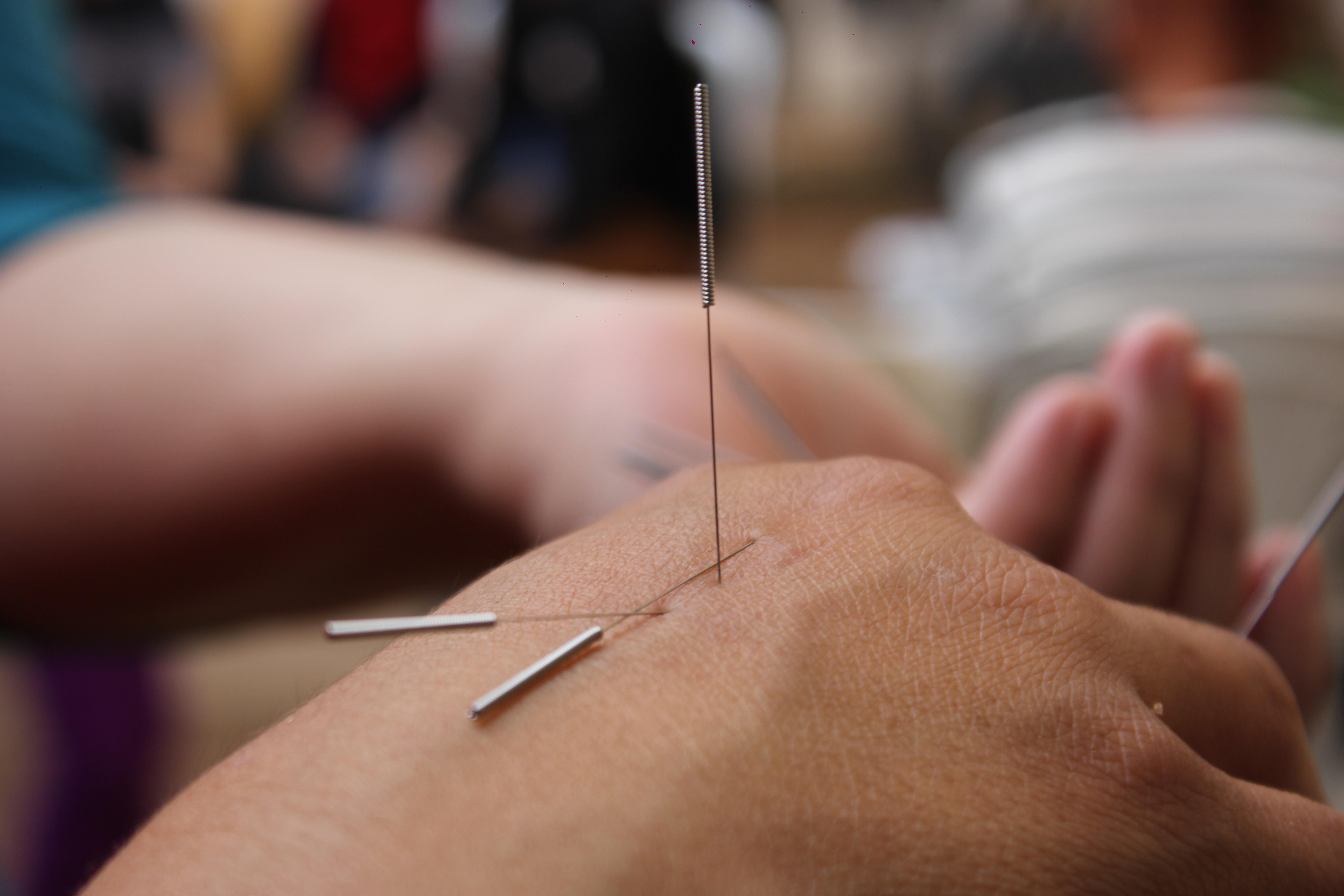 professional acupuncture treatment with sterile needles